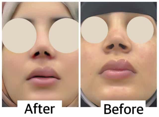 حالة تجميل انف قبل و بعد 3